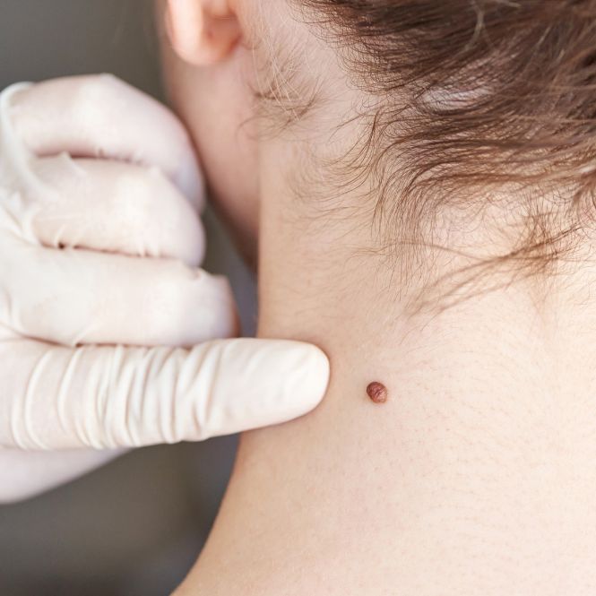 Young woman has a mole on the back of her neck checked