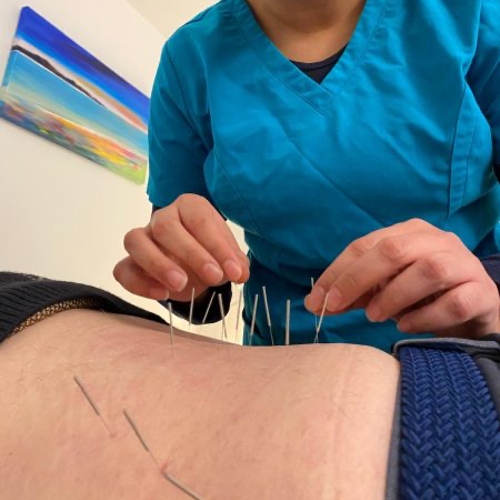 Client receiving acupuncture treatment at The Lomond Clinic, Helensburgh