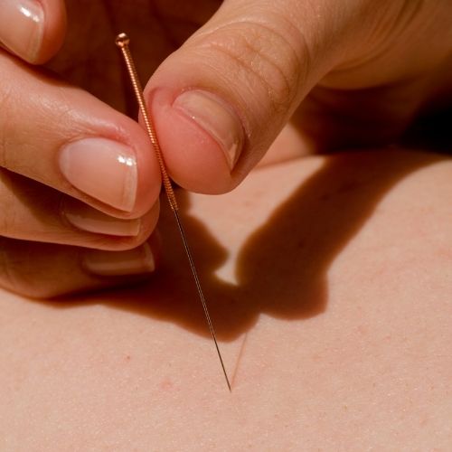 Close up of acupuncture needle