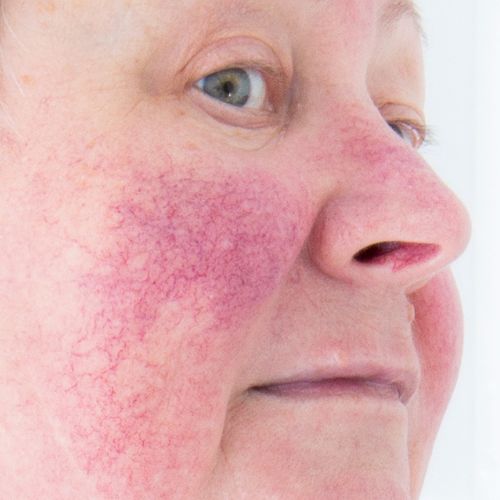 Lady with broken capillaries on her face